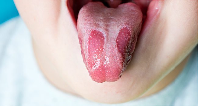 Nấm lưỡi: Nguyên nhân, nhận biết và điều trị