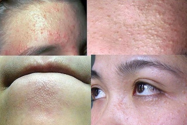 8 bước đơn giản ‘lột sạch’ mụn ẩn, chăm chỉ thực hiện da còn đẹp hơn trông thấy